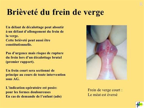 rupture du frein du prepuce|Tout savoir sur la rupture du frein